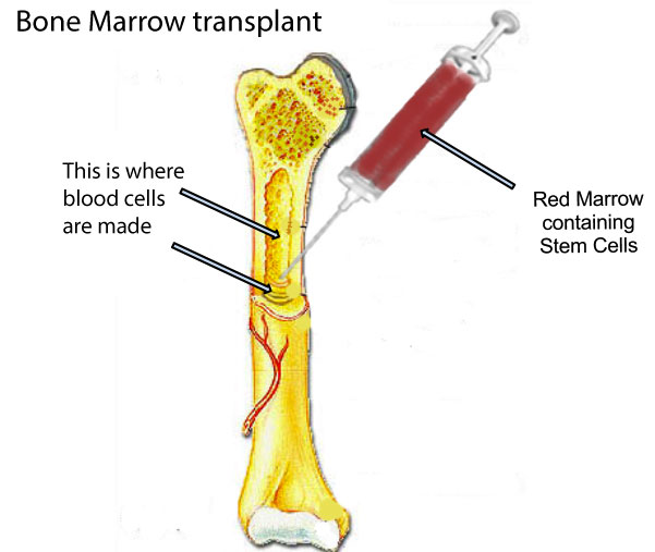 bone marrow transplant diagram